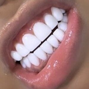 Facette , offrir un nouveau sourire