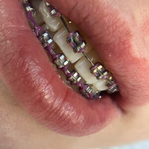 Брекеты + расширение челюсти